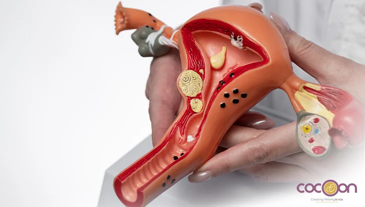 Ovarian Cyst Surgery in Jaipur – Laparoscopic Treatment and Cost